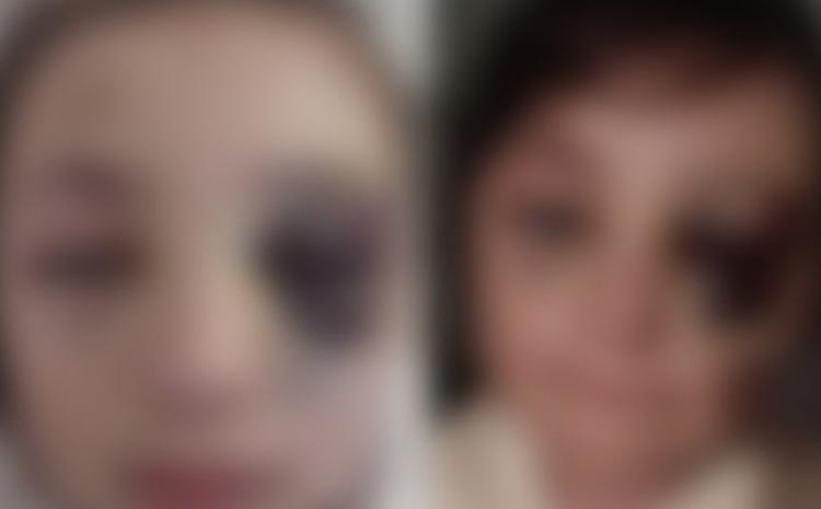 Məktəblinin döyülməsi iddiaları təsdiqini tapmayıb 