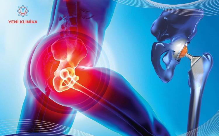 Avropa istehsalı olan endoprotezlər Yeni Klinikada 