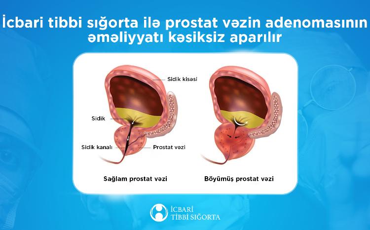 İcbari tibbi sığorta ilə prostat vəzin adenomasının əməliyyatı kəsiksiz aparılır 