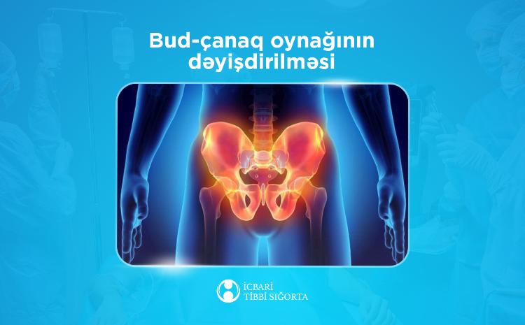 İcbari tibbi sığorta bud-çanaq oynağının süni protezlə dəyişdirilməsi əməliyyatını qarşılayır 
