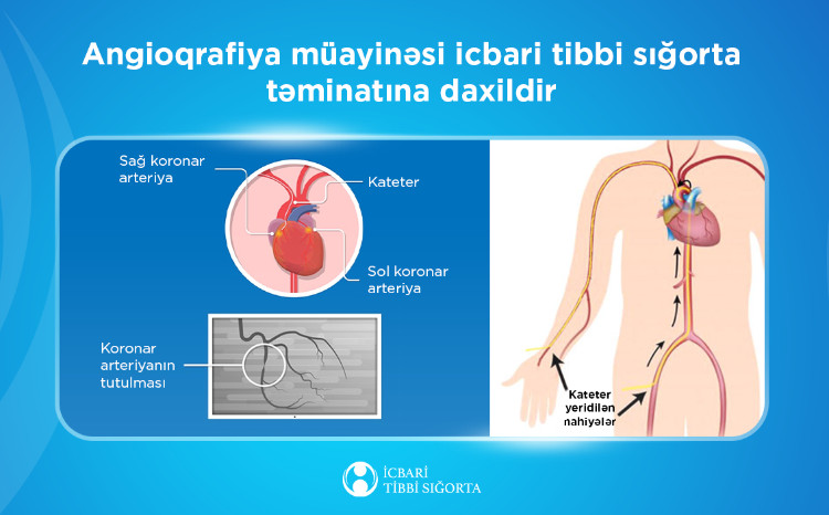 İcbari tibbi sığorta ilə 50 mindən artıq angioqrafiya müayinəsi aparılıb 