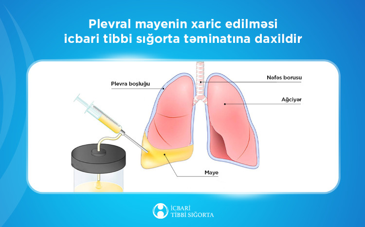 Ağciyərlərə yığılmış mayenin çəkilməsi məqsədilə 5643 prosedur icra olunub 