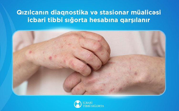 Qızılcanın diaqnostika və stasionar müalicəsi icbari tibbi sığorta hesabına qarşılanır 