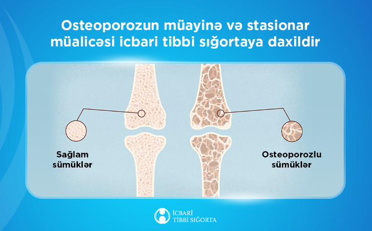 Osteoporozun müayinə və stasionar müalicəsi icbari tibbi sığortaya daxildir 