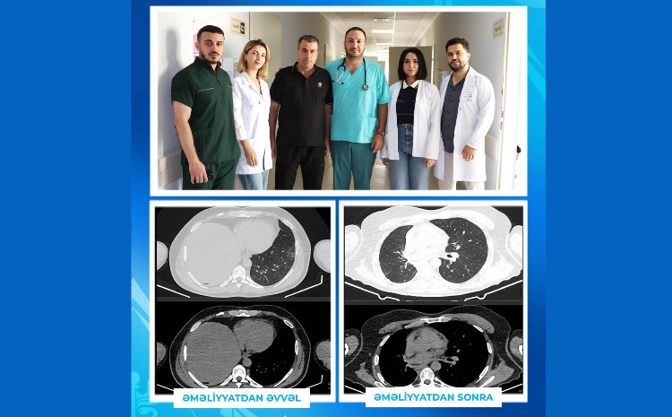 İki uzman həkim əməliyyat etdi, onkoloji xəstə sağaldı 