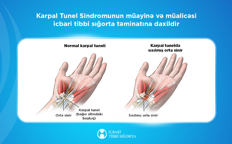 Karpal Tunel Sindromunun müayinə və müalicəsi icbari tibbi sığorta təminatına daxildir 