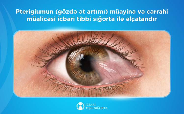 Pterigiumun (gözdə ət artımı) müayinə və cərrahi müalicəsi icbari tibbi sığorta ilə əlçatandır 
